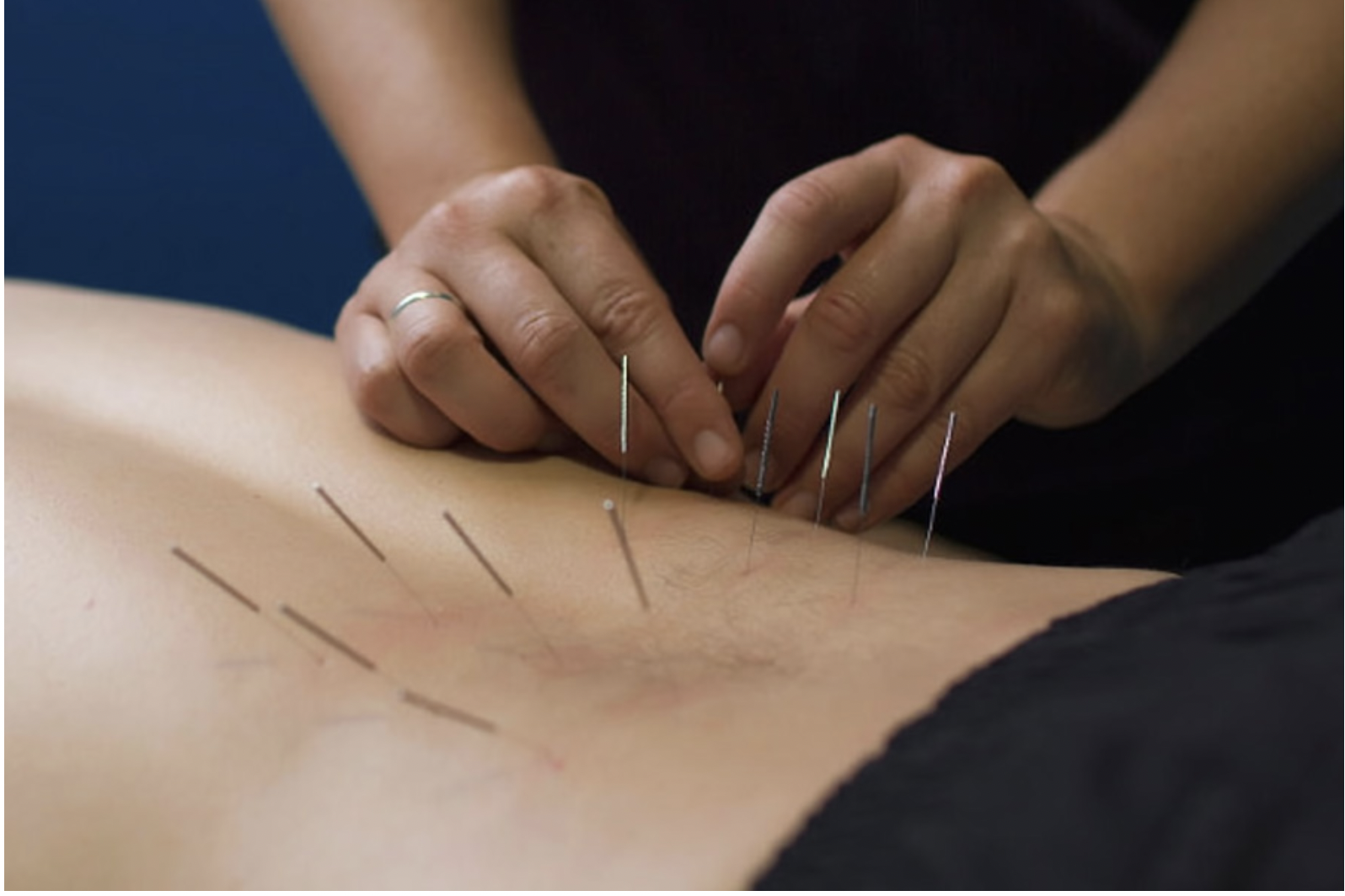 Viddhkarma Needle Therapy Treatment